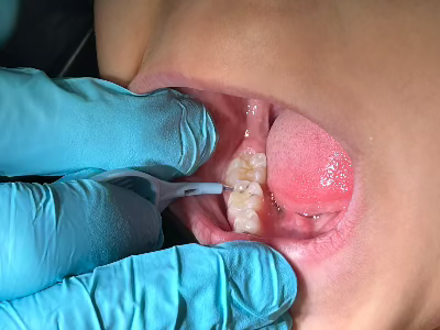 CaviSense Toothpick dispenser (contains 100 toothpicks)